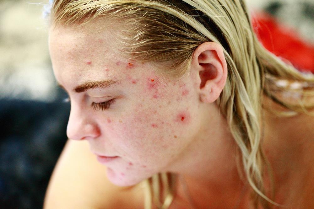 Unveiling the Emotional Depths of Acne