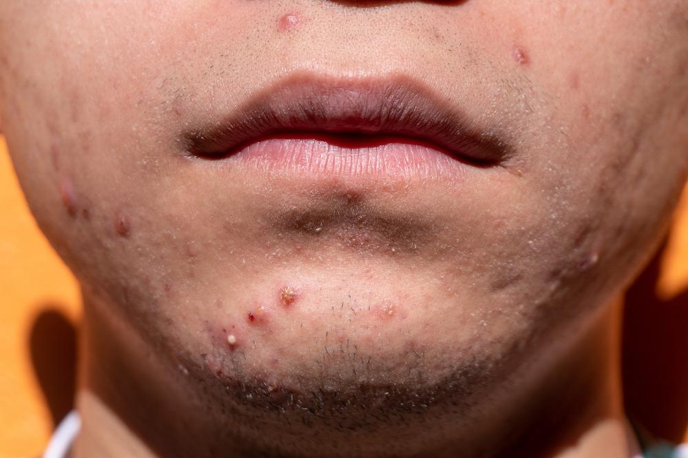 Holistic Approaches to Acne Treatment