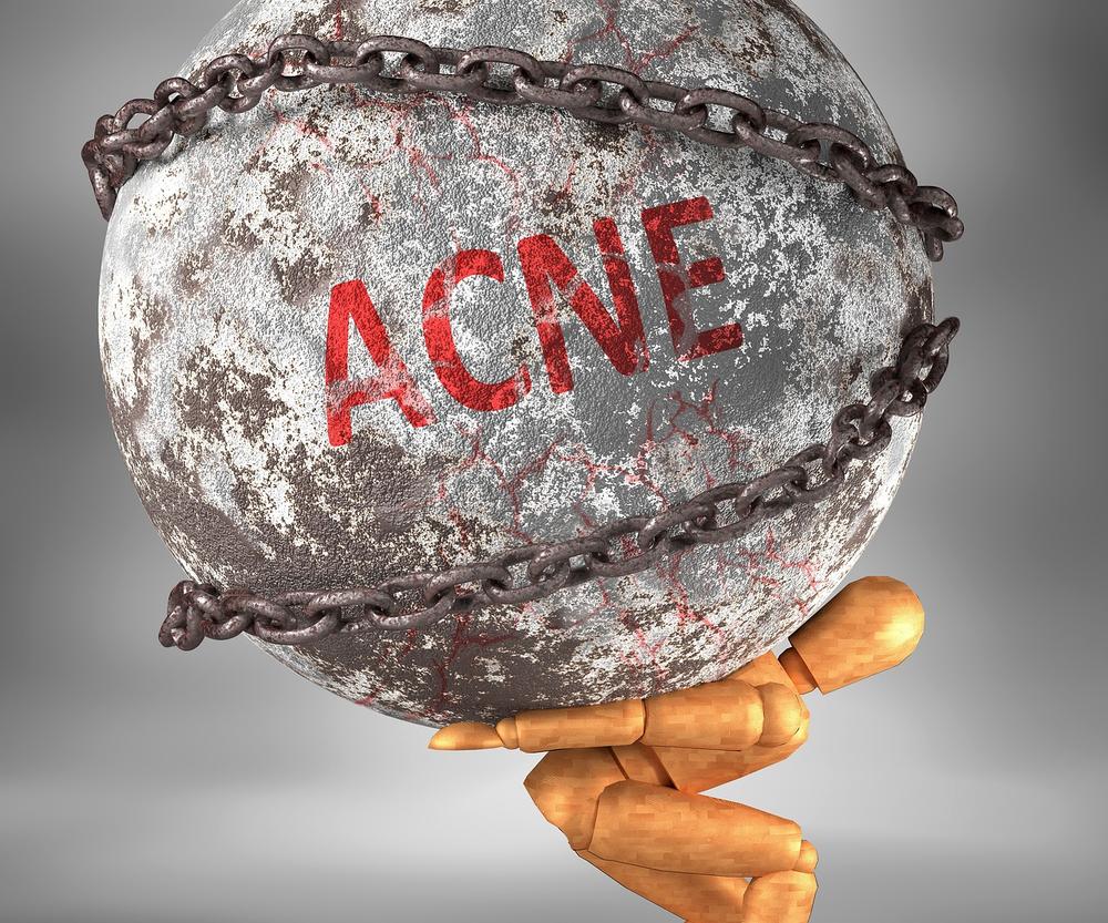 Understanding Acne From a Spiritual Perspective